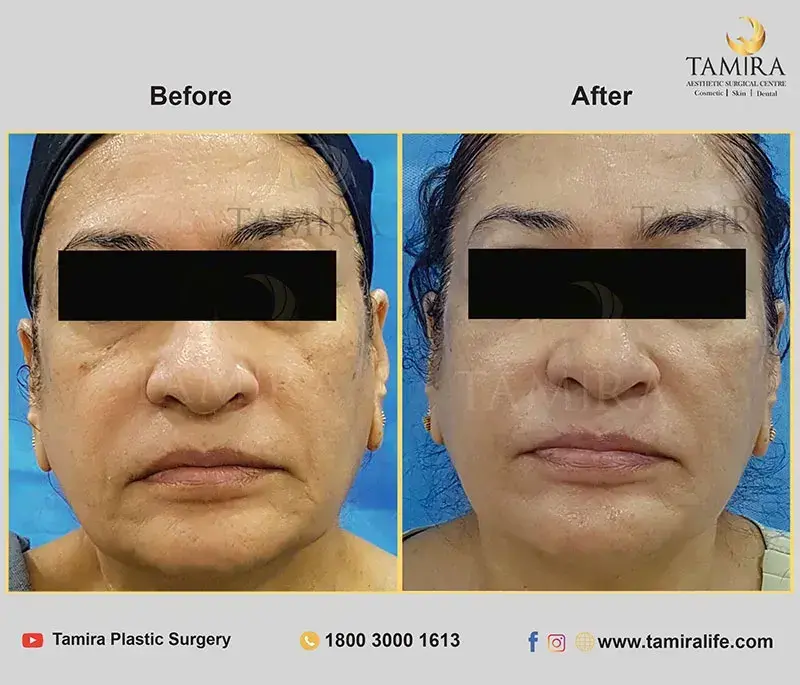 Non Invasive RF Skin tightening - Thermage - Chin - Before & After