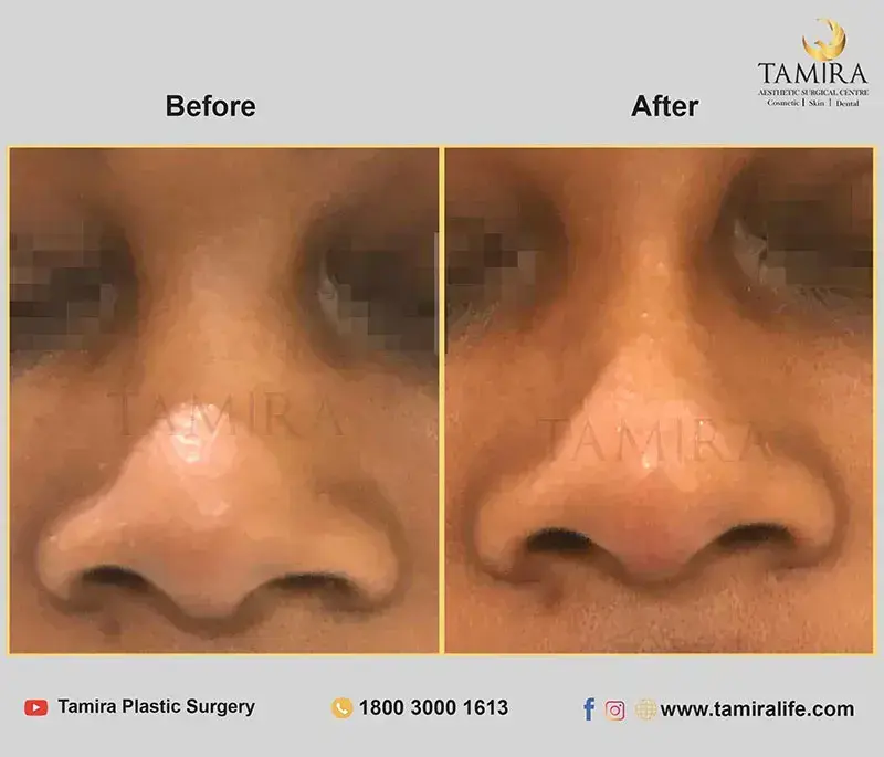 nueromodulator injections (botox) - Before & After