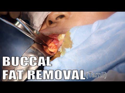 Buccal Fat Removal - Before & After