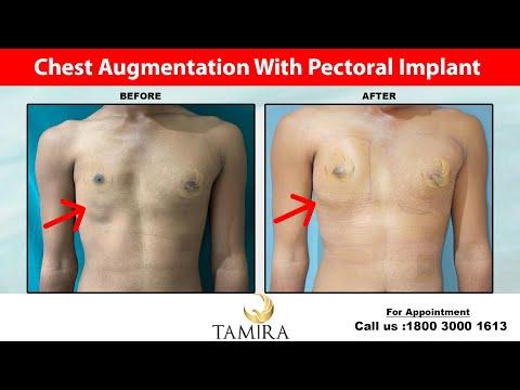 Pectoral Implant (Chest Implant) - Before & After