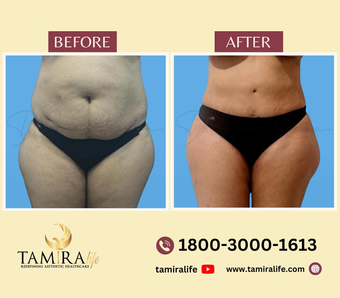 Tummy Tuck - Before & After