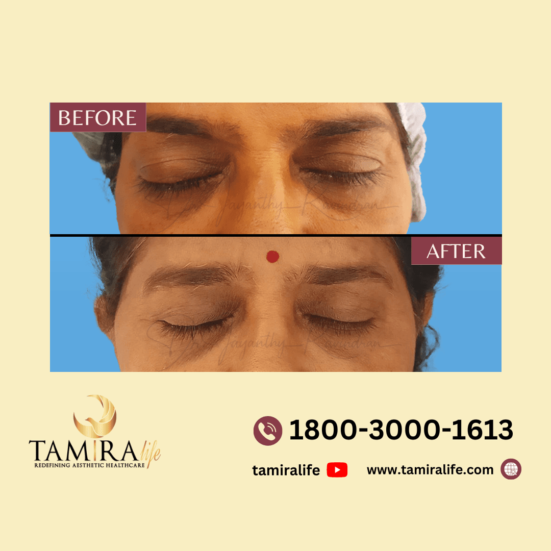 Upper eyelid blepharoplasty 