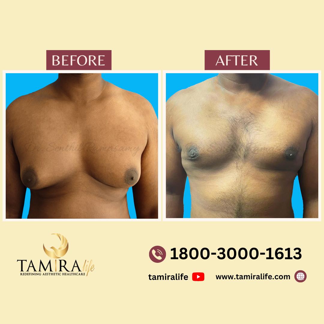 gynecomastia surgery