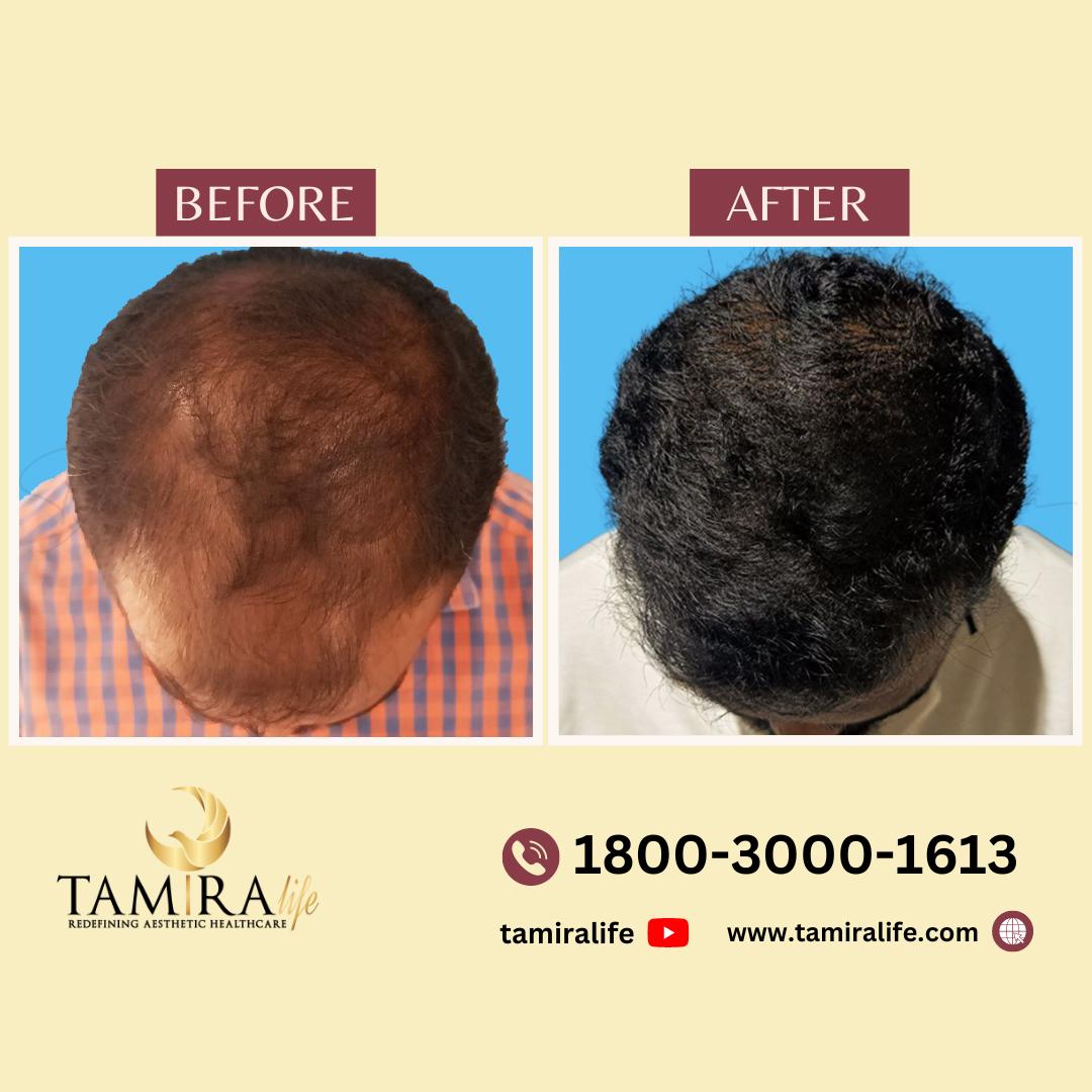 Hair Transplant