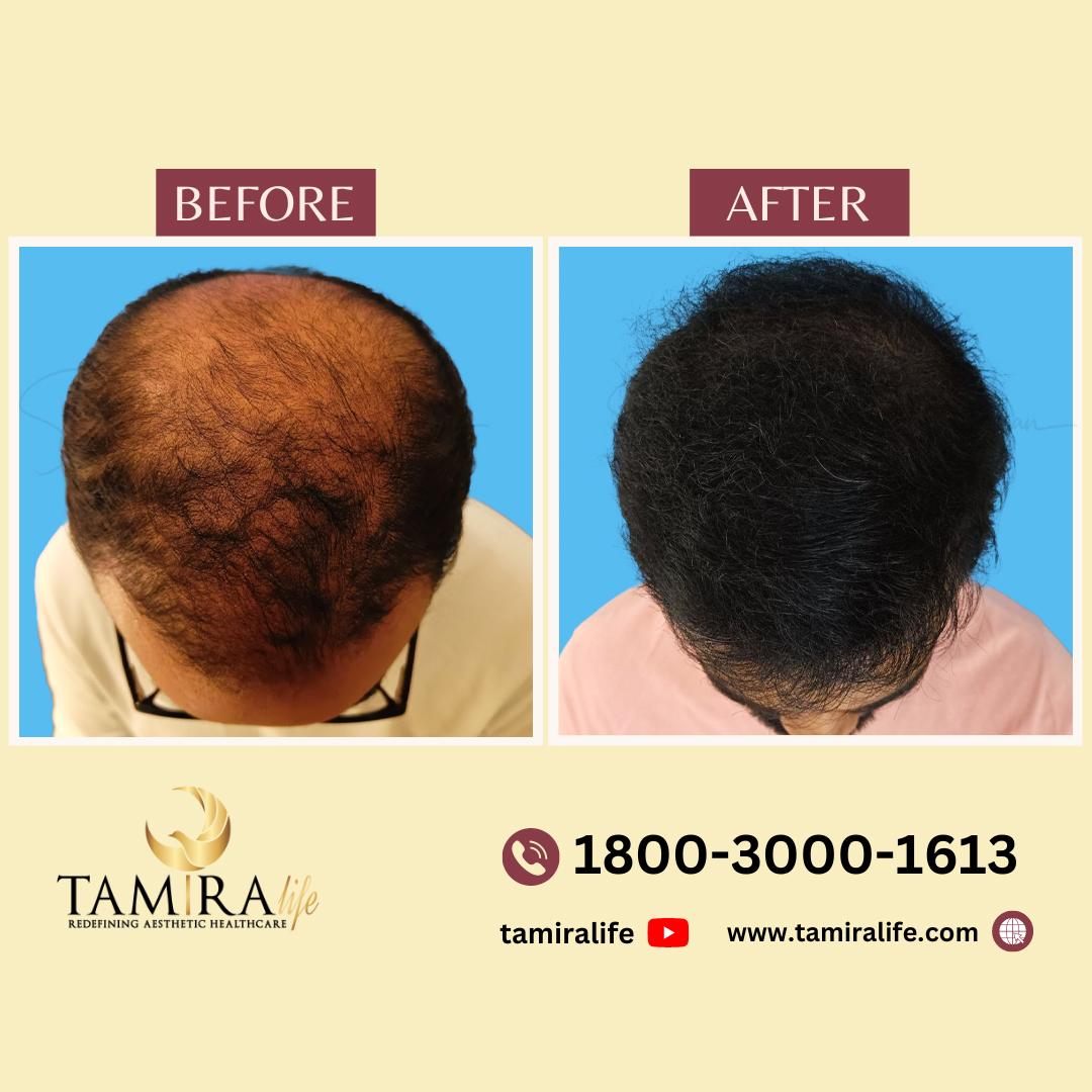 Hair Transplant