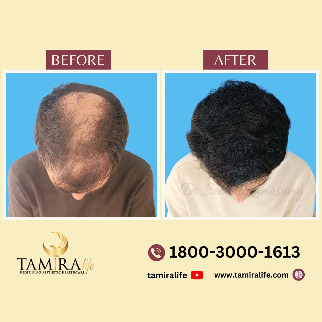 Hair Transplant