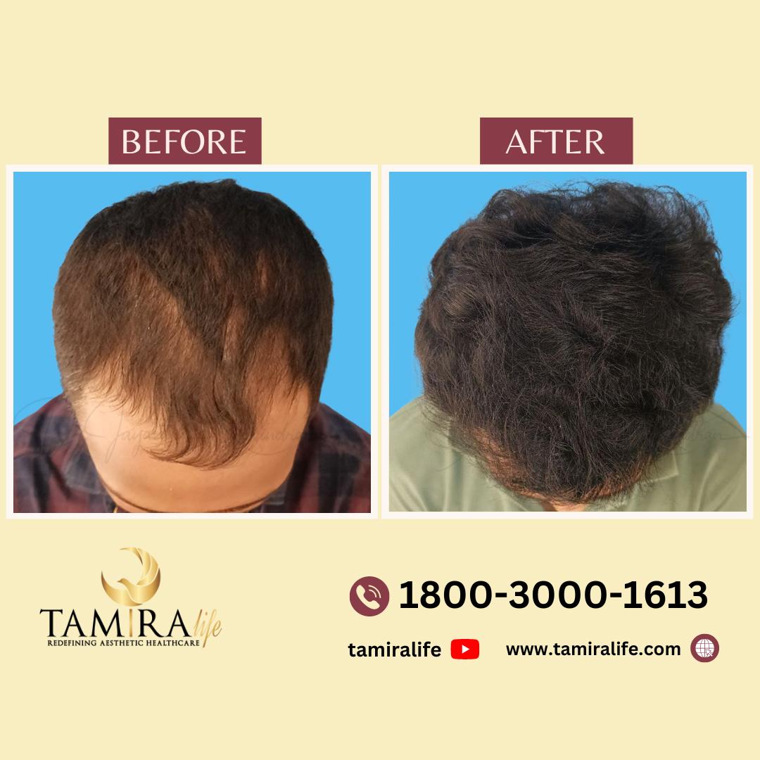 Hair Transplant