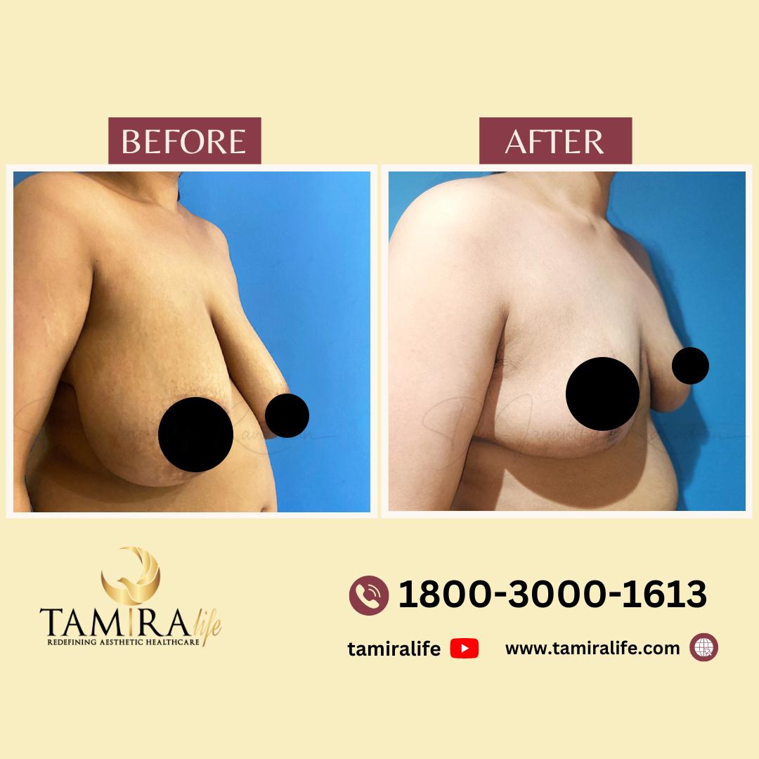 Breast Reduction