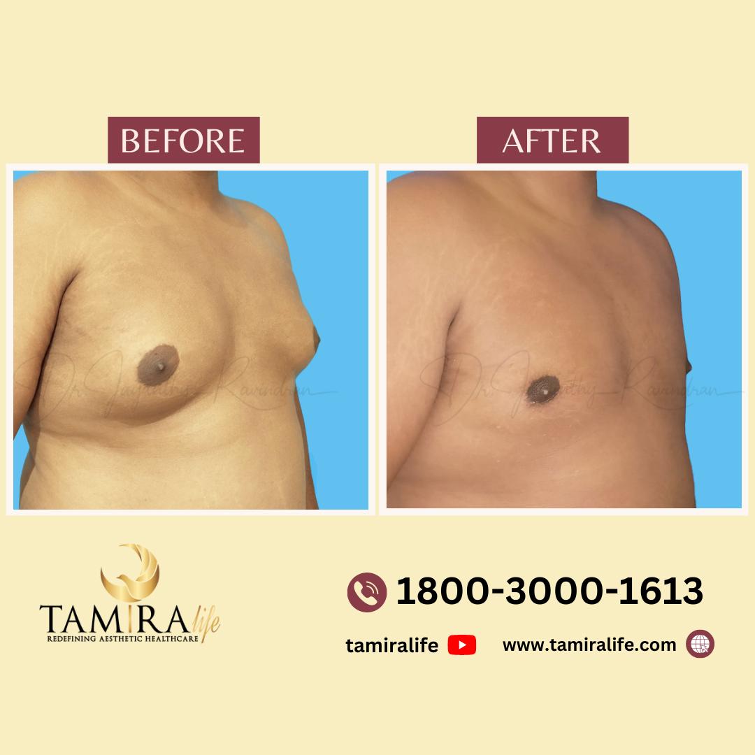 gynecomastia