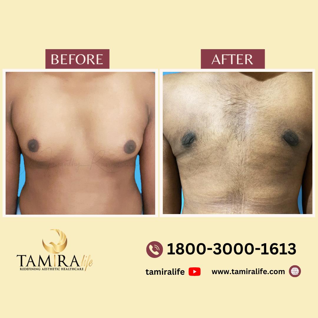 Gynecomastia