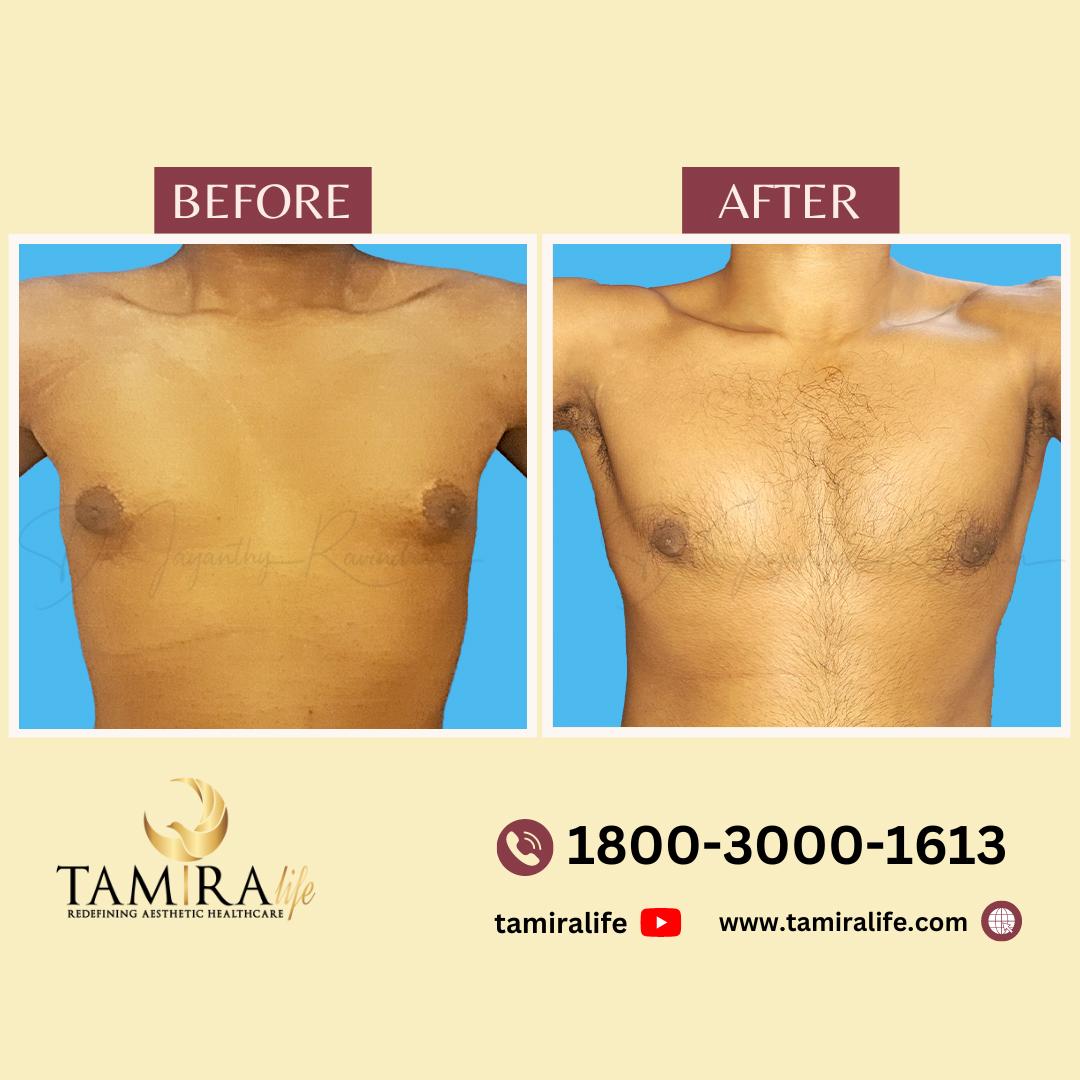 Gynecomastia