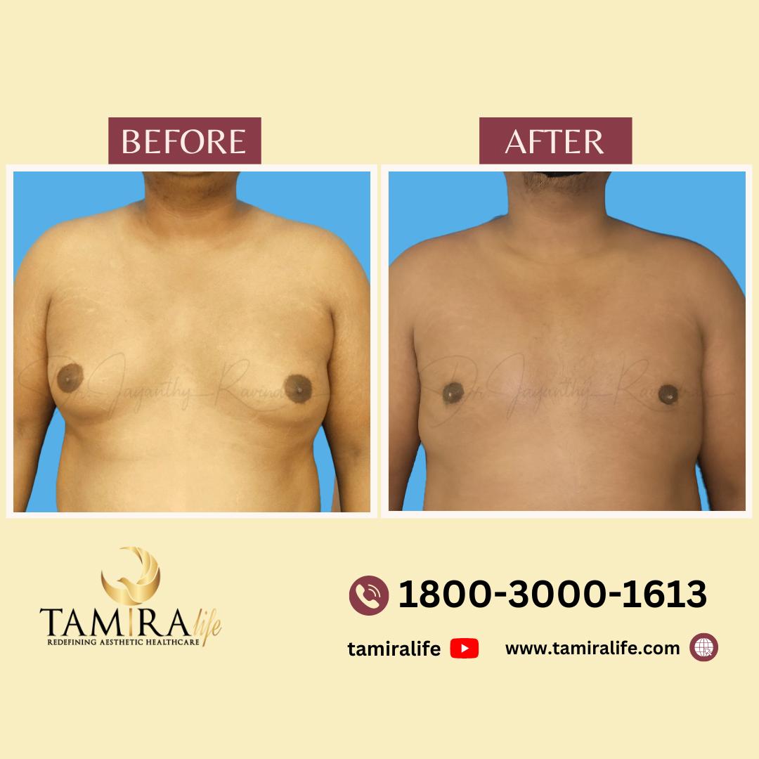 Gynecomastia