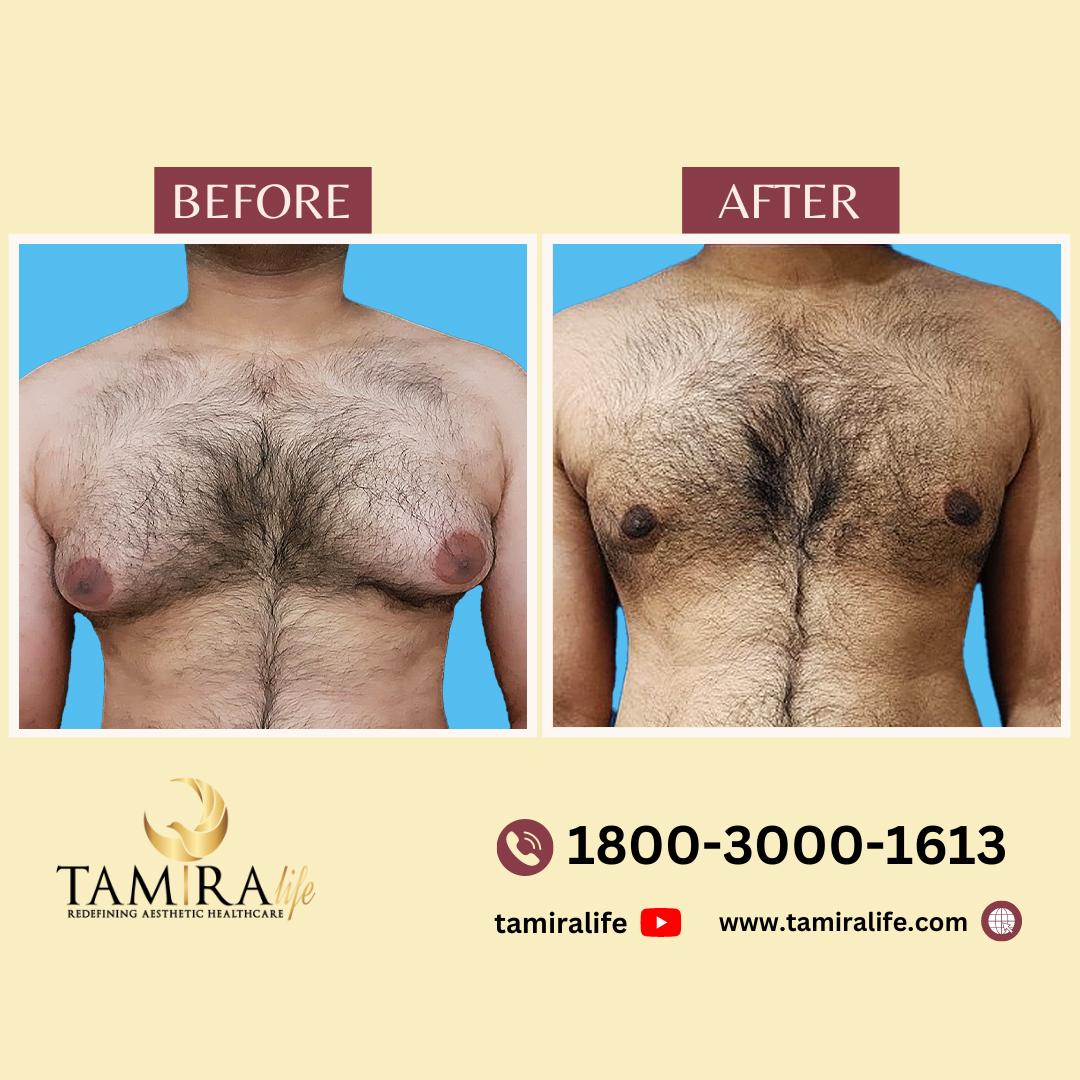 Gynecomastia