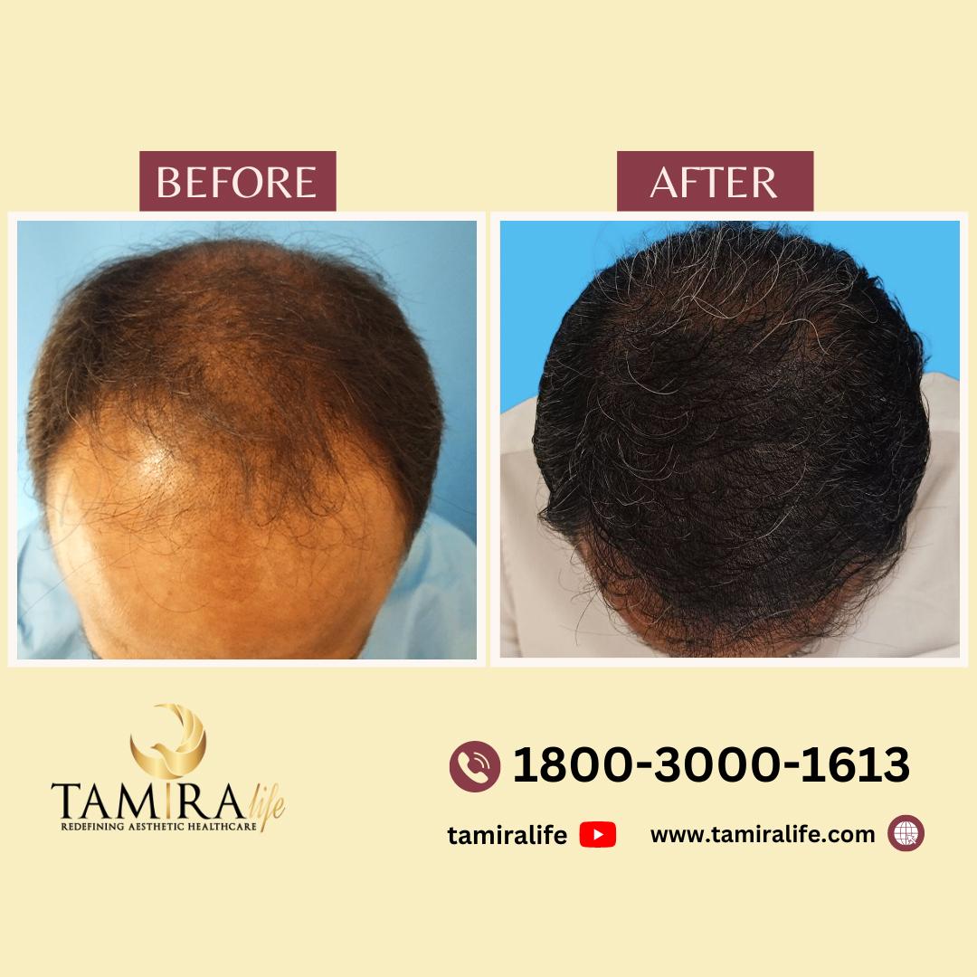 hair Transplant