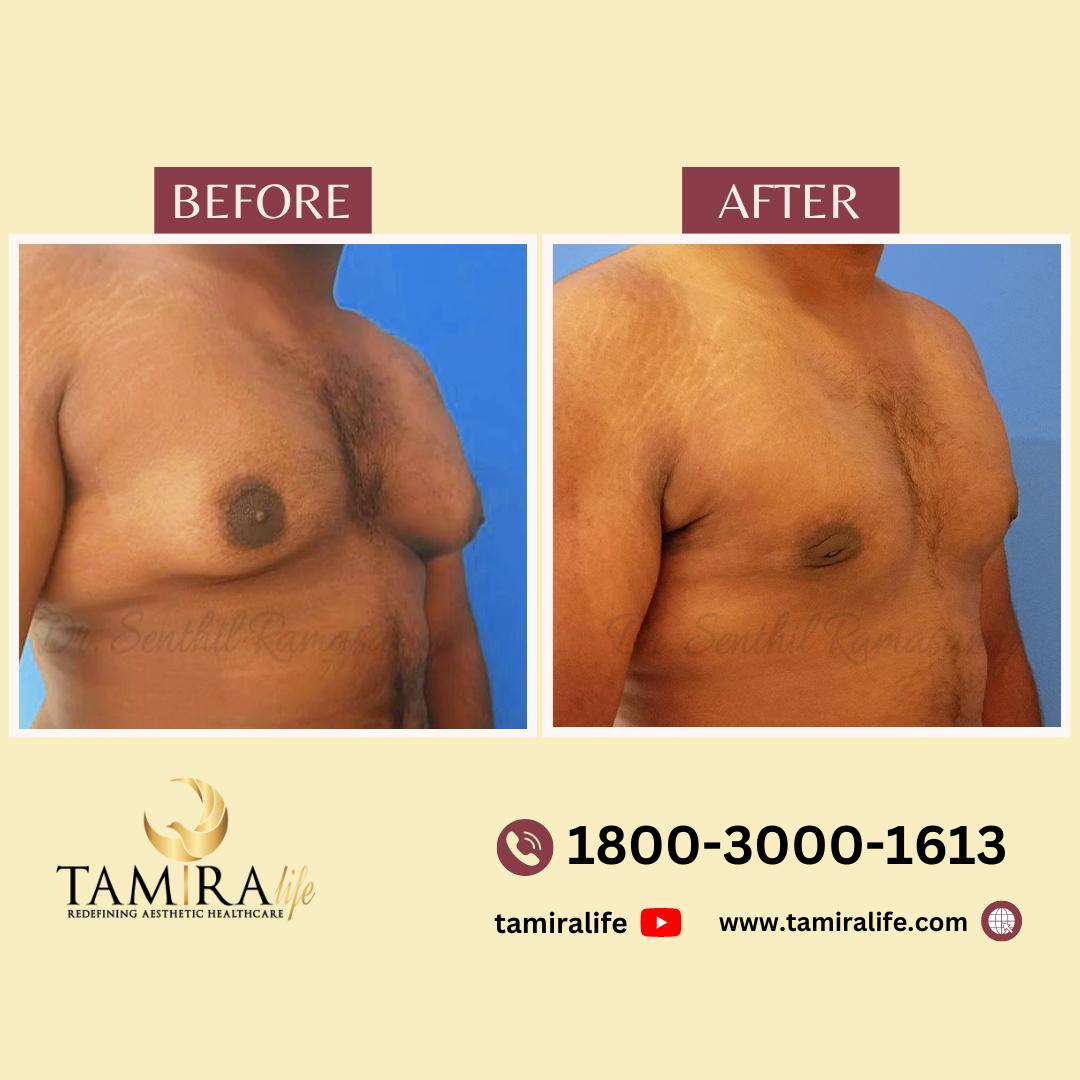 gynecomastia