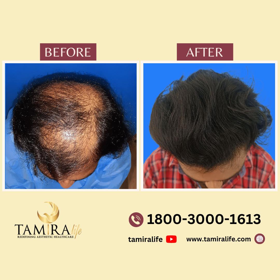 Hair transplant