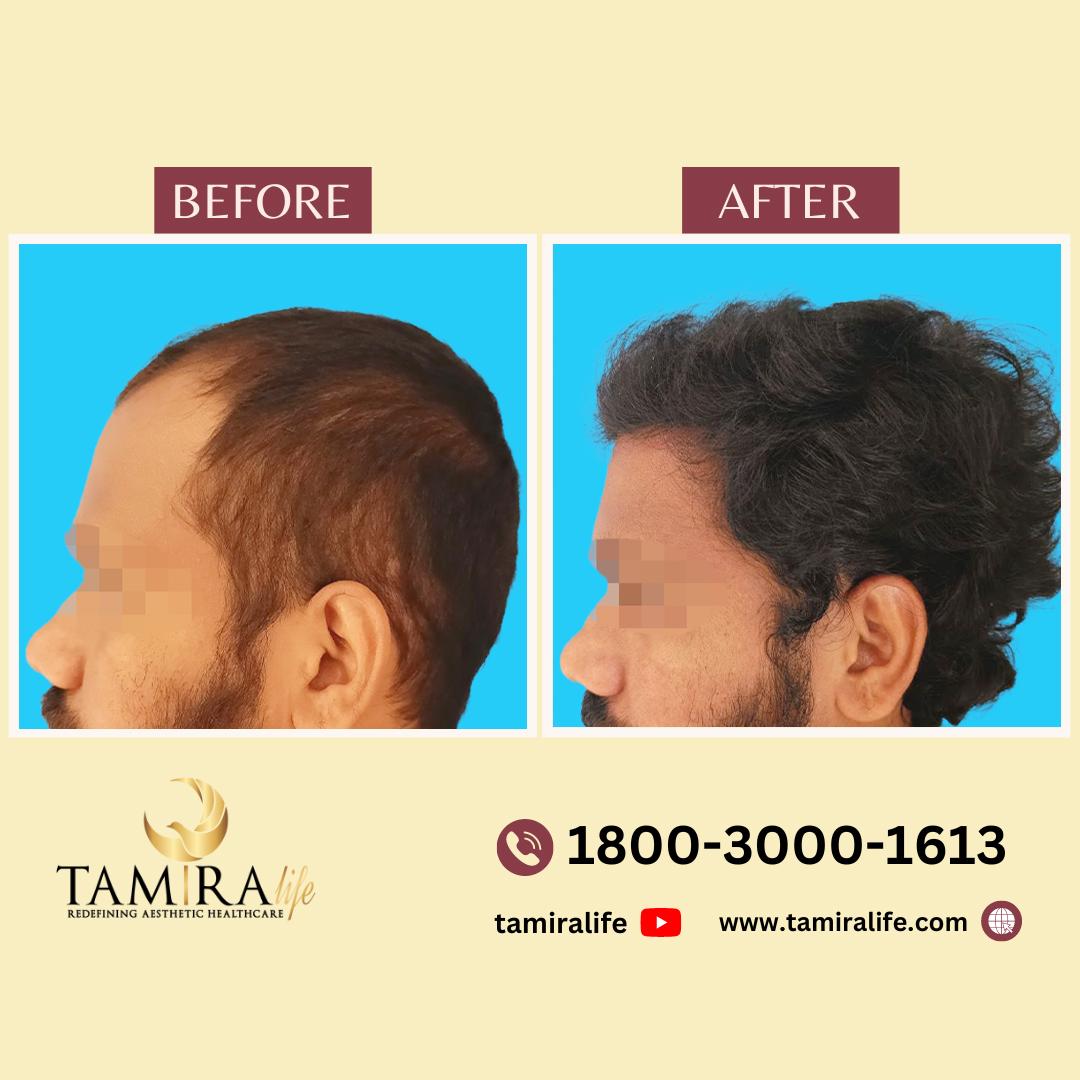 hair transplant