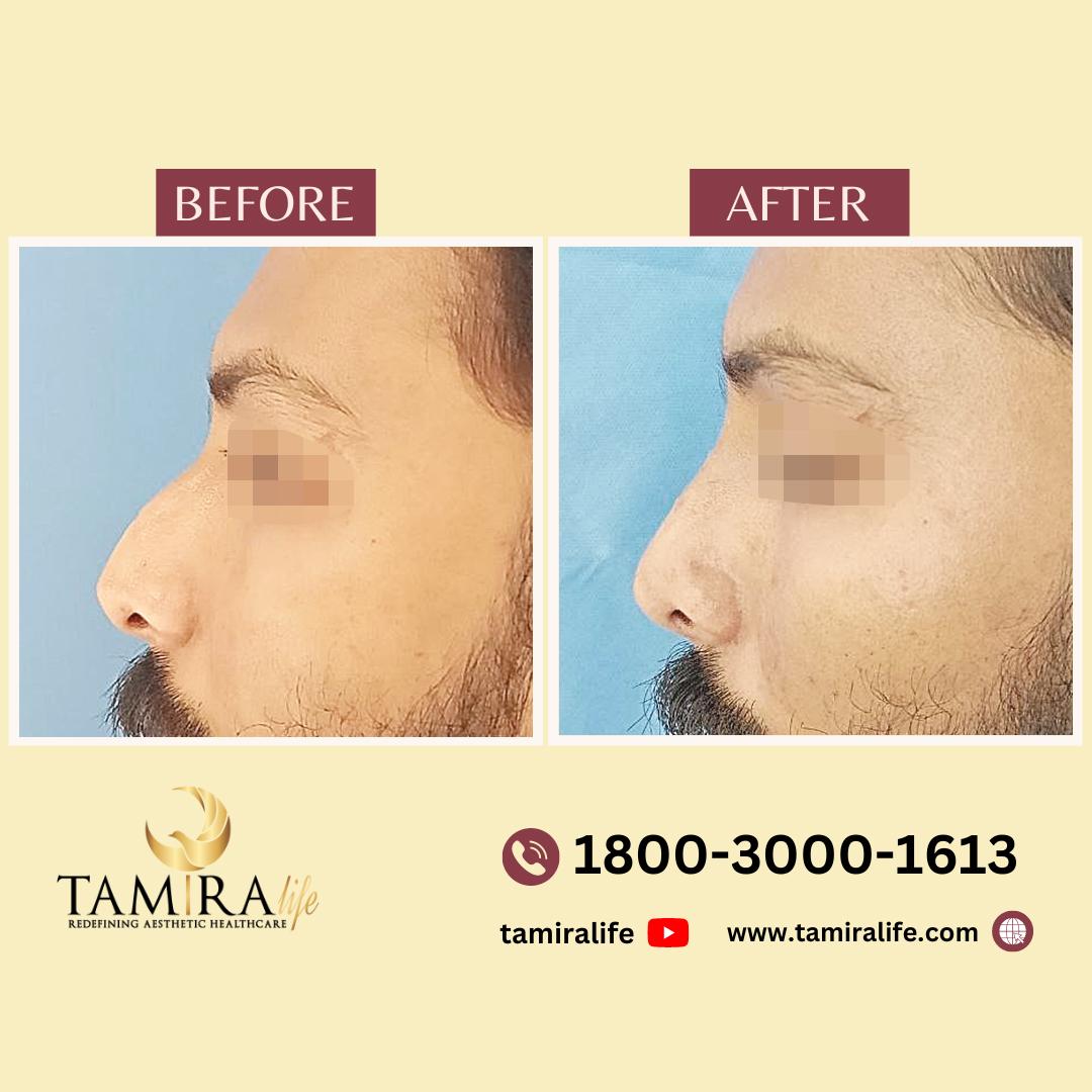 Rhinoplasty