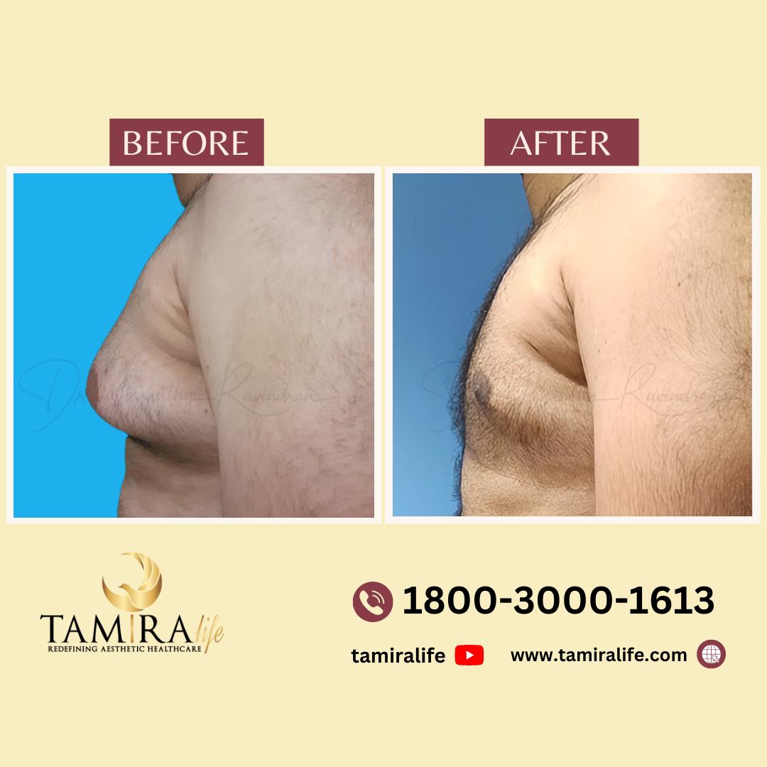 gynecomastia