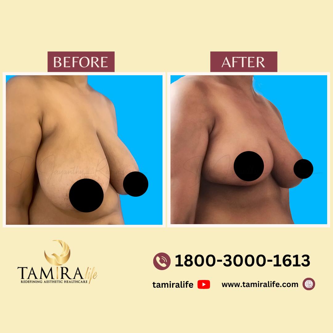 Breast Reduction