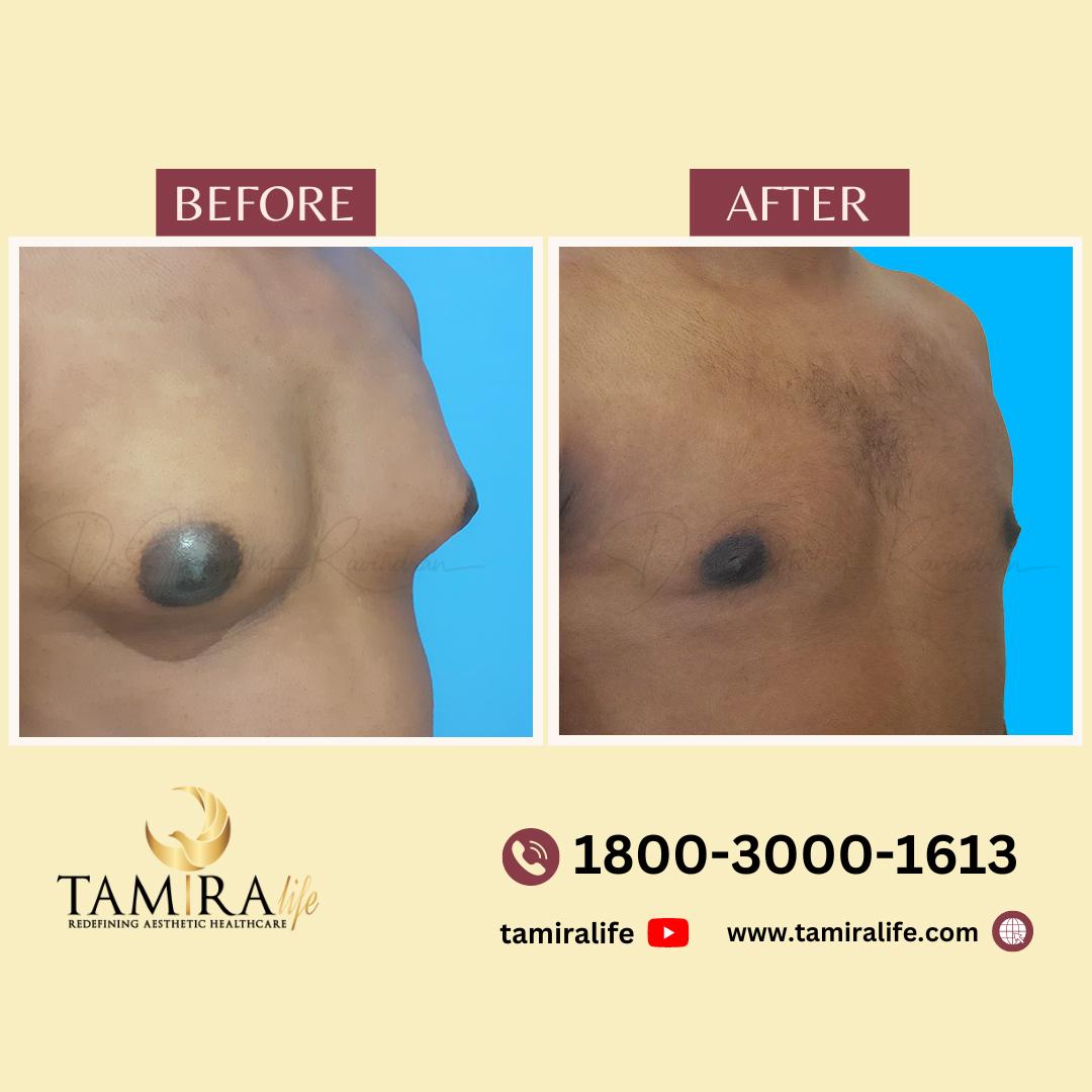 gynecomastia