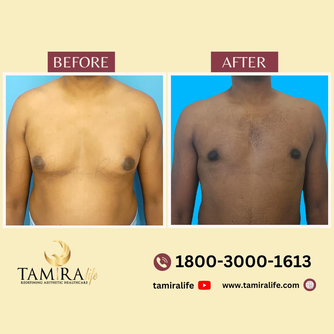 gynecomastia