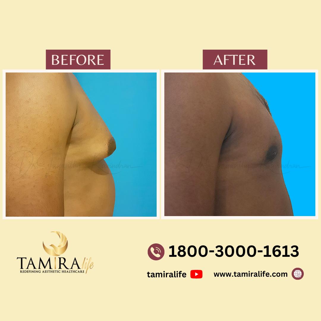 gynecomastia