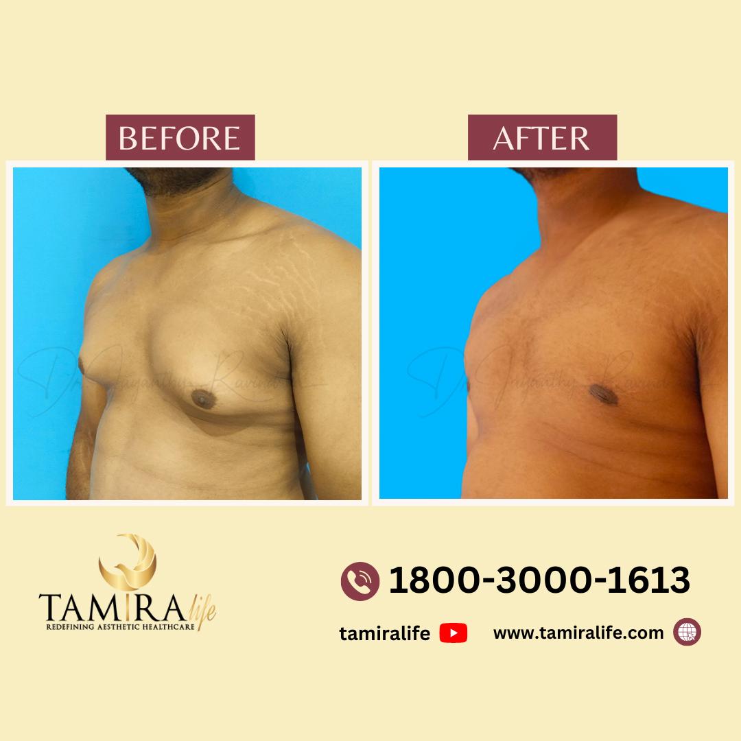 gynecomastia