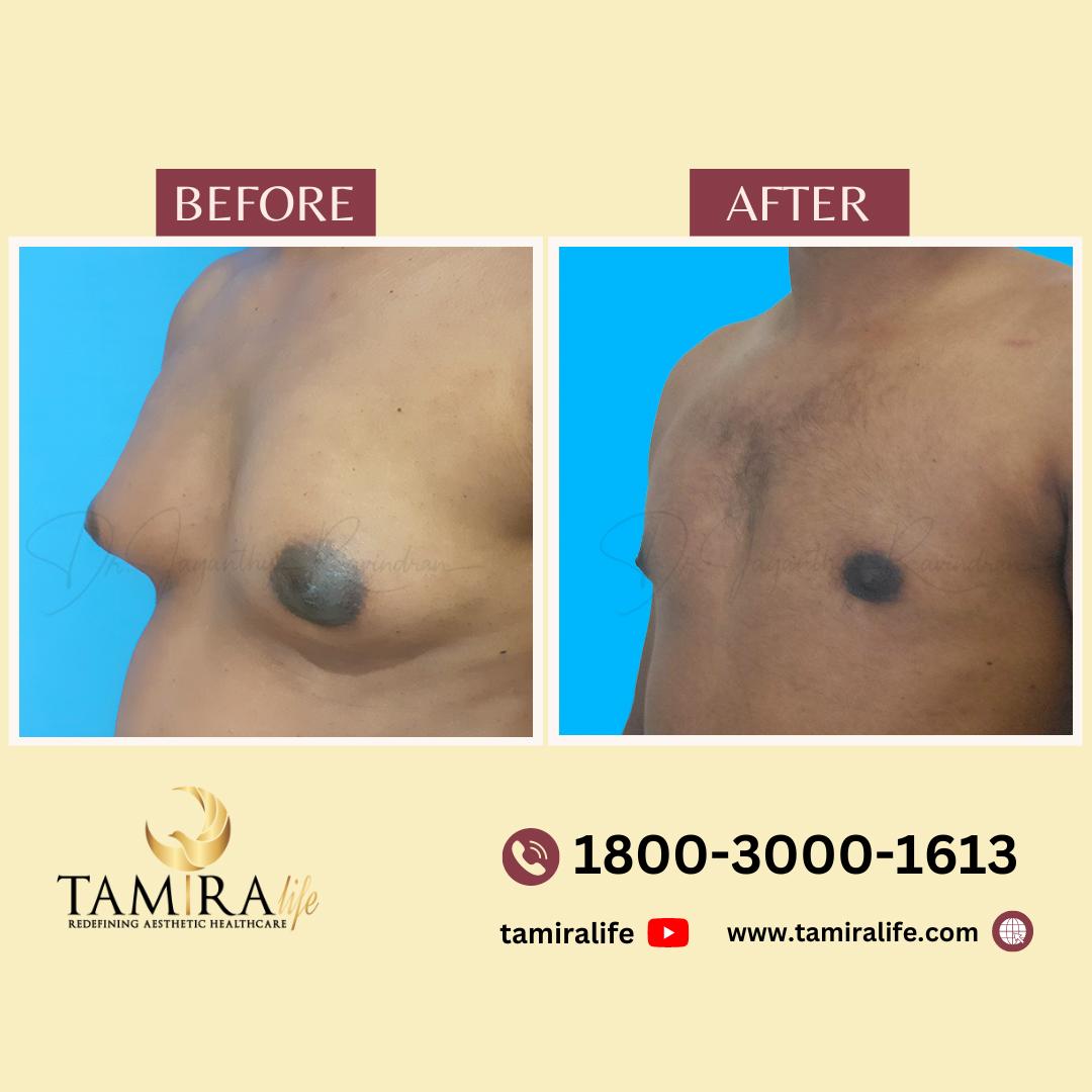 gynecomastia