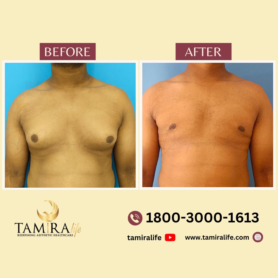 gynecomastia