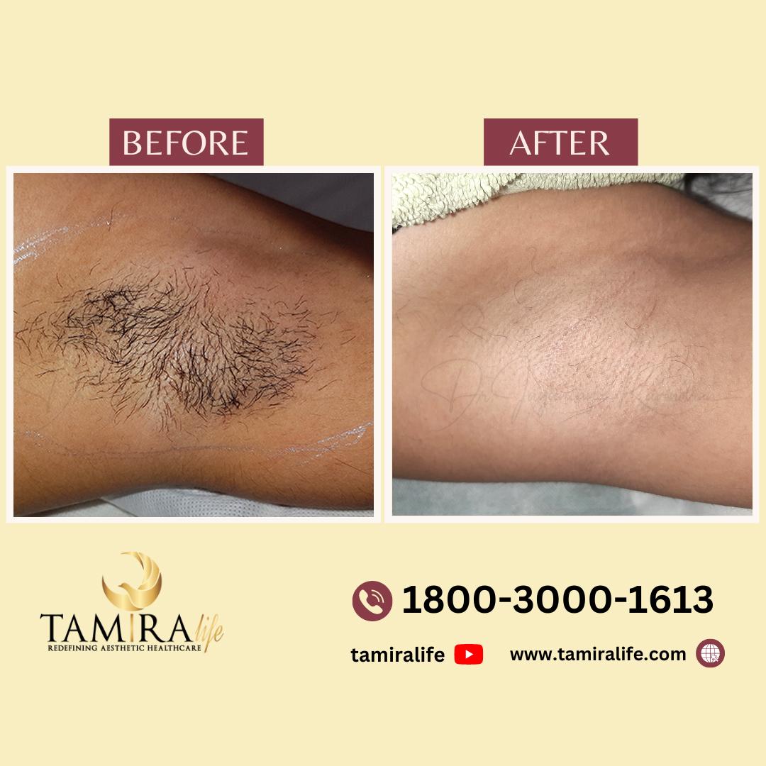 laser hair removal