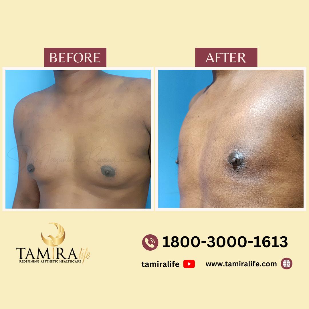 gynecomastia