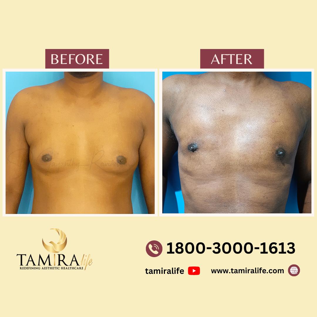 gynecomastia