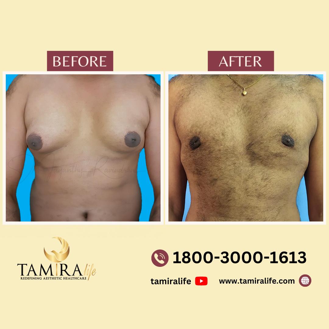 gynecomastia