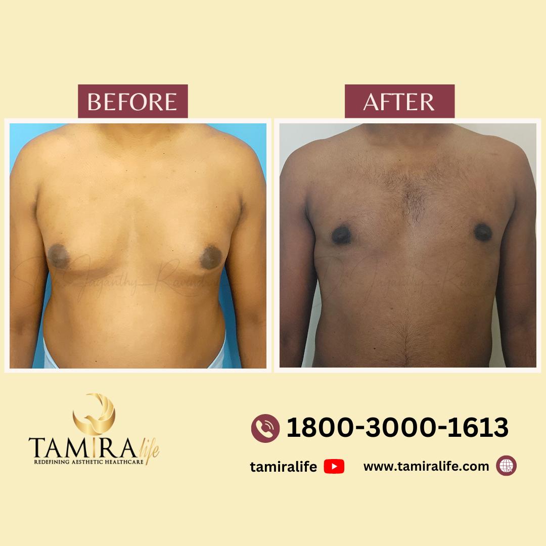 gynecomastia