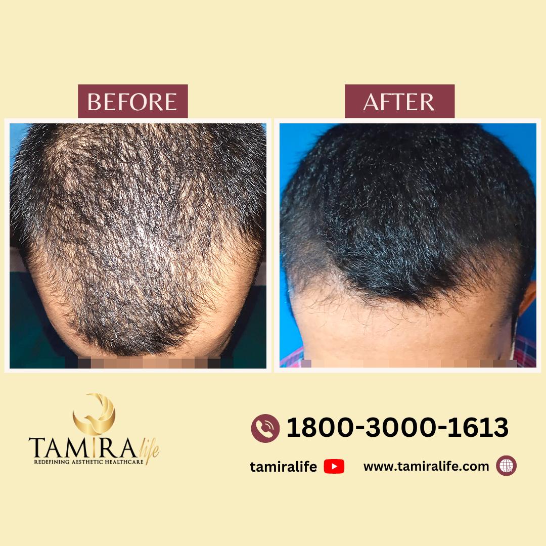 Hair Transplant