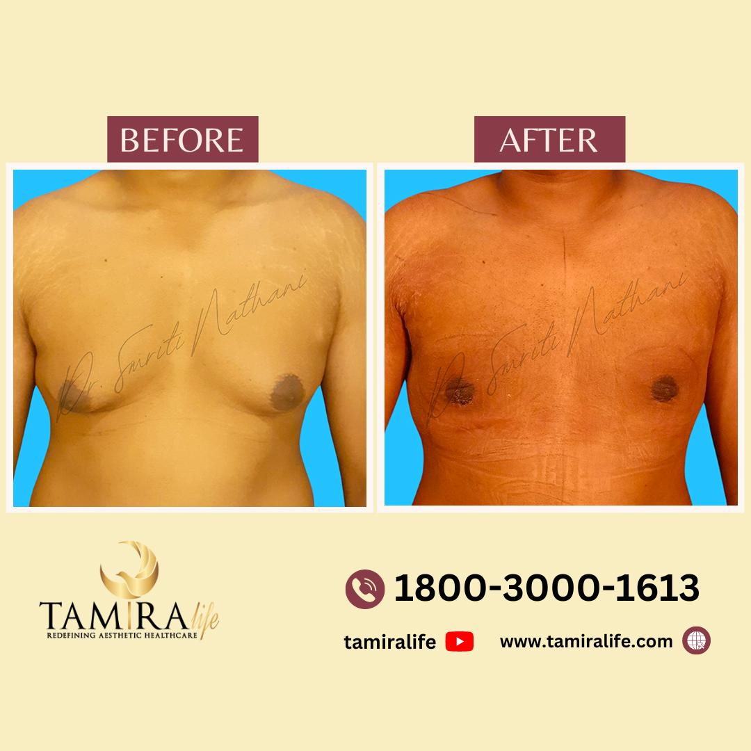 Gynecomastia