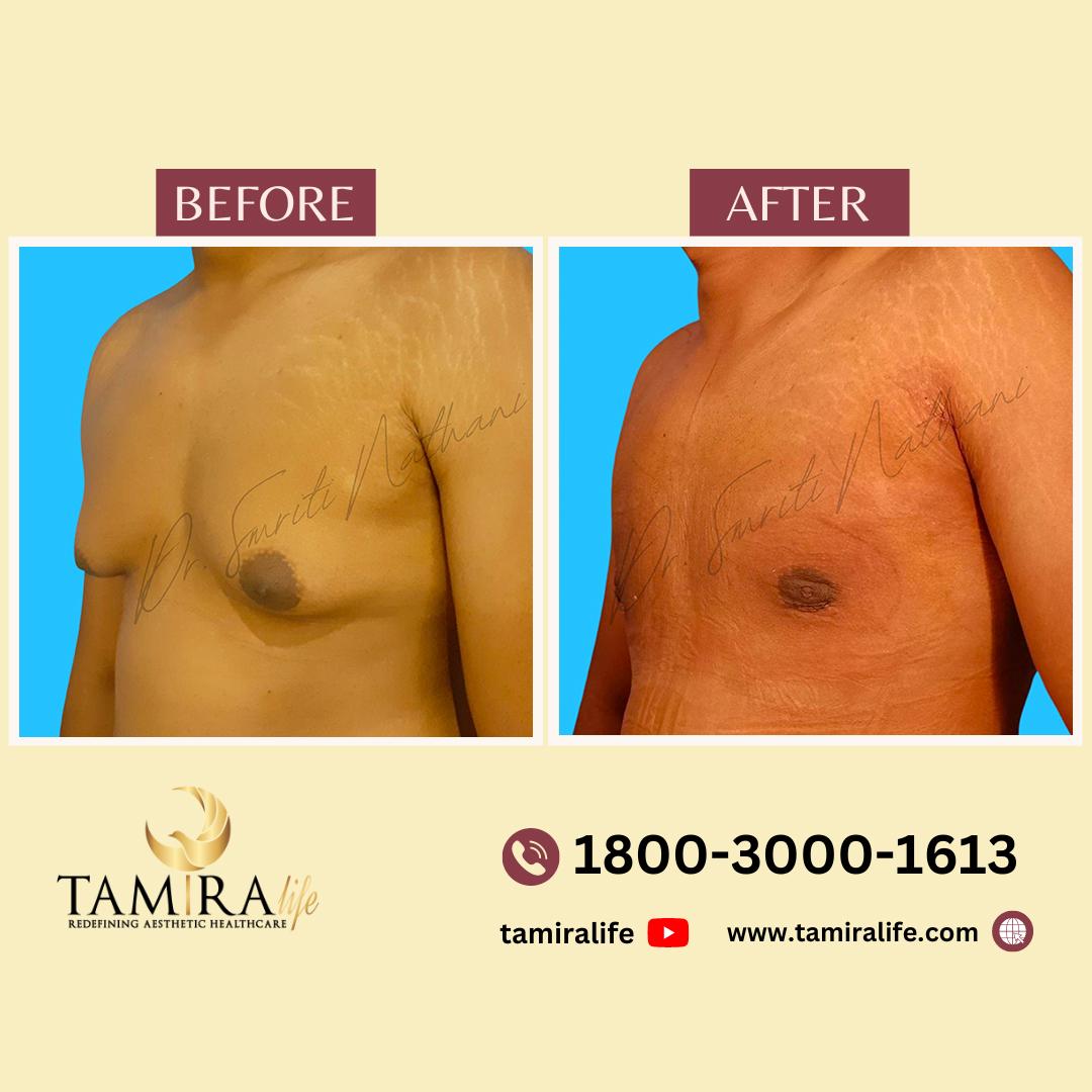 Gynecomastia