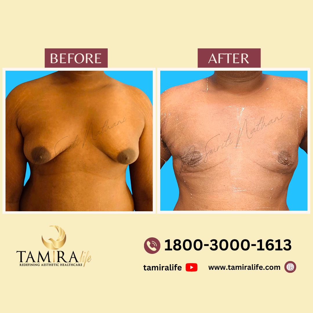 Gynecomastia