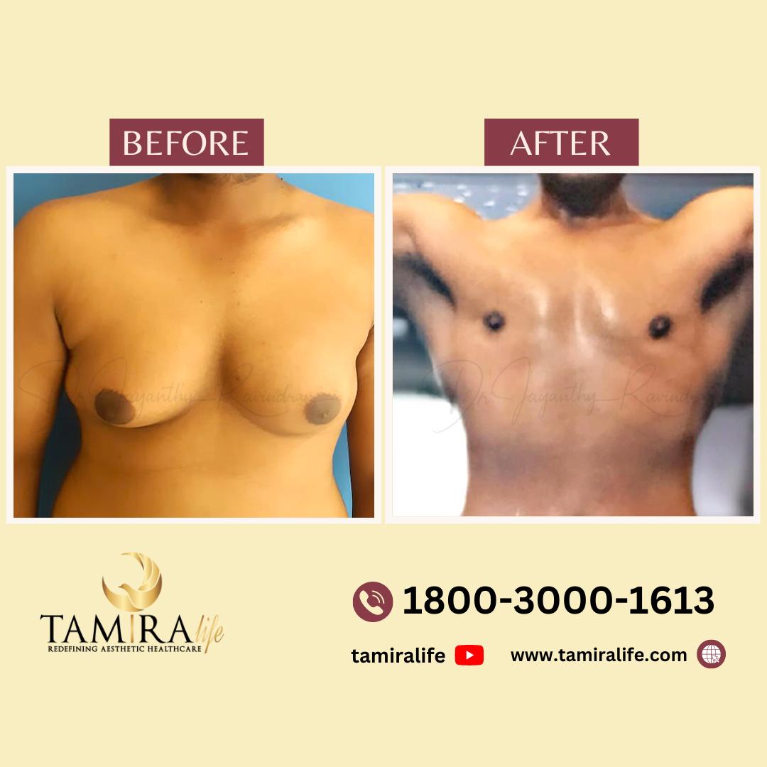 Gynecomastia