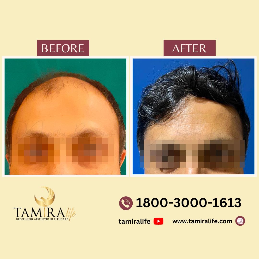 Hair Transplant