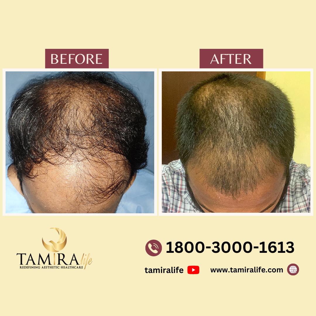 Hair Transplant