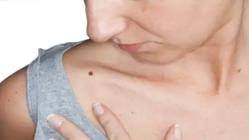 Mole in the shoulder of a woman