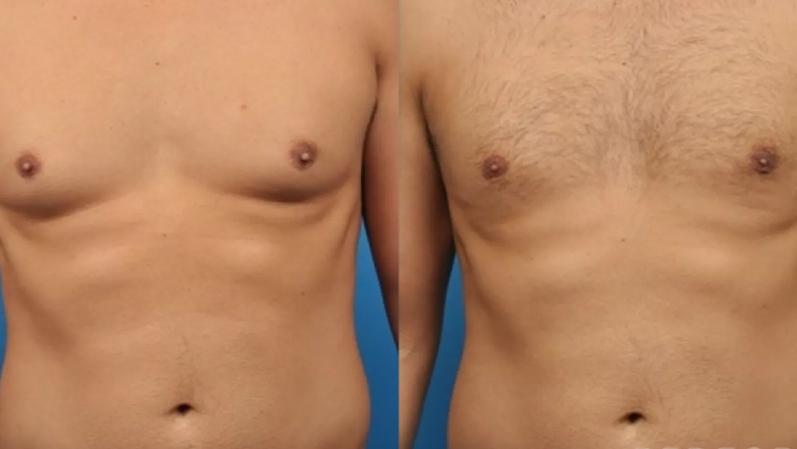 Understanding Gynecomastia: Causes, Treatment, and Recovery