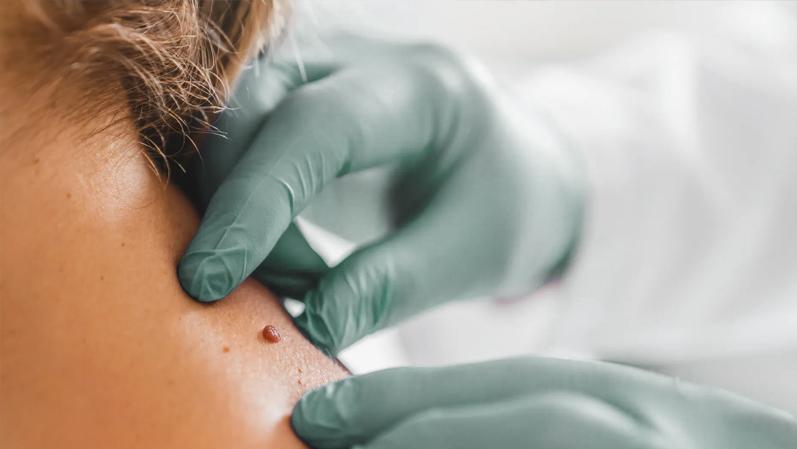 Professional Skin Tag Removal