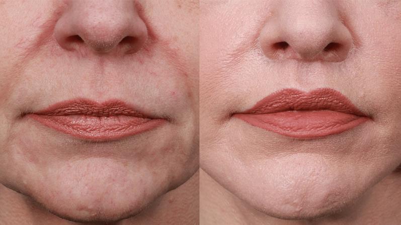 Lip Lift Surgery