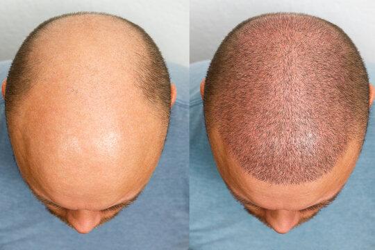  Hair transplant in Chennai