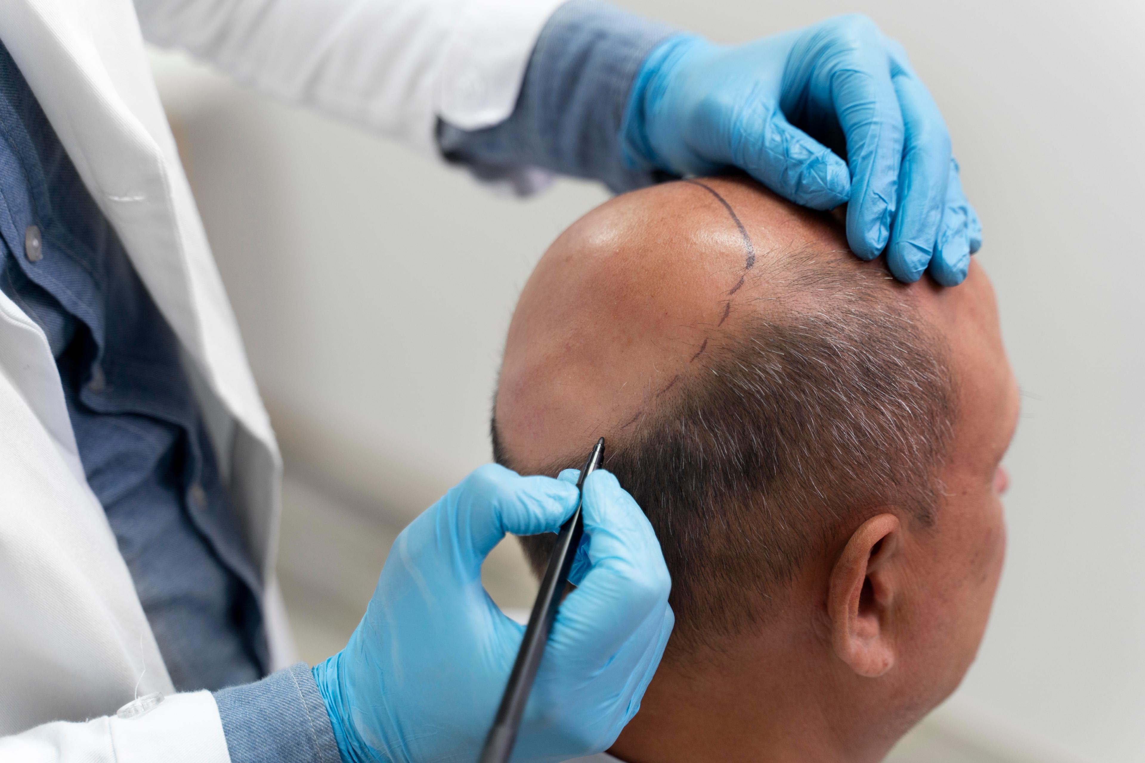  Hair transplant in Chennai