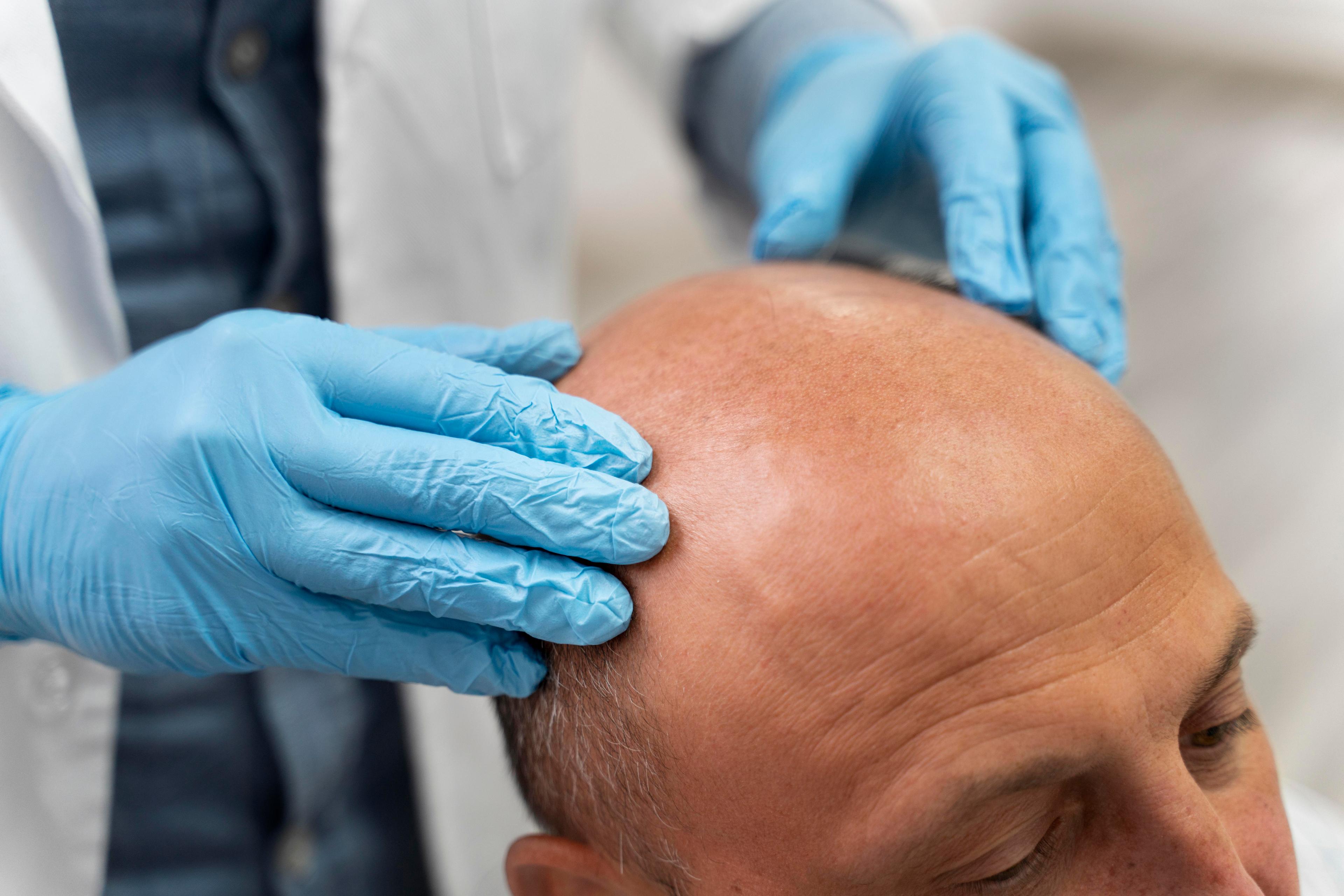  Hair transplant in Chennai