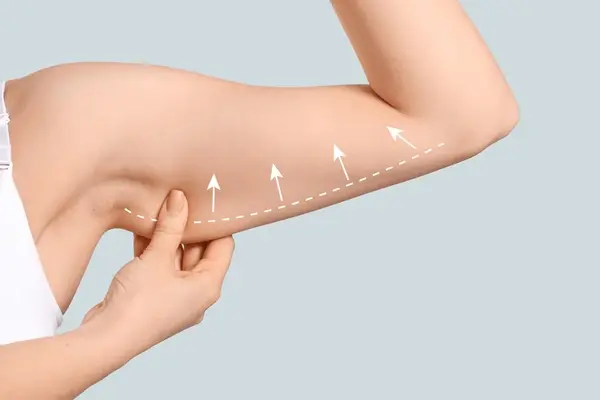  Liposuction in chennai